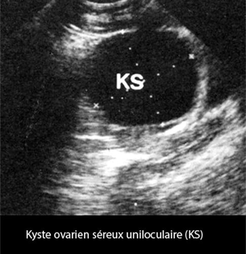 Kyste ovarien séreux