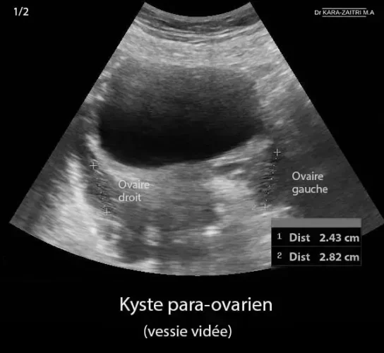 Kyste para-ovarien 2