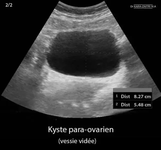Kyste para-ovarien 1