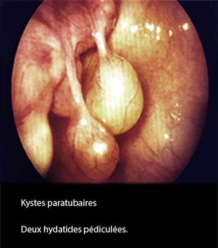 Kyste paratubaire coelioscopie — kyste para-ovarien 3