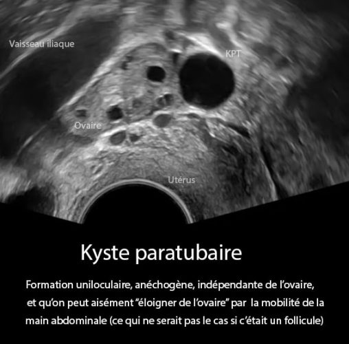 Kyste paratubaire — kyste para-ovarien échographie pelvienne