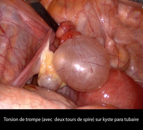 Kyste paratubaire torsion — urgence gynécologique coelioscopie