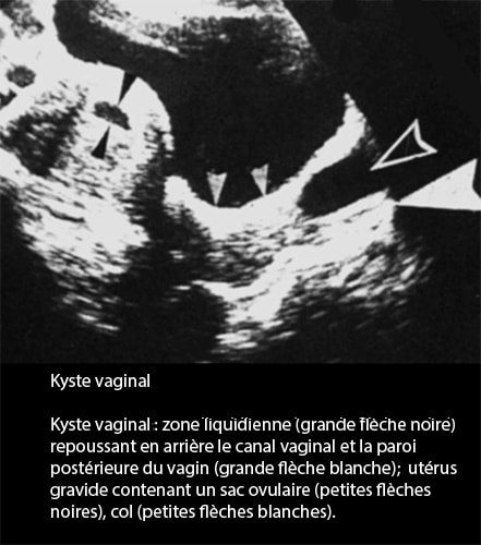 Kyste vaginal