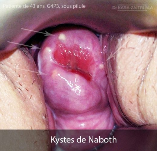 kyste de naboth