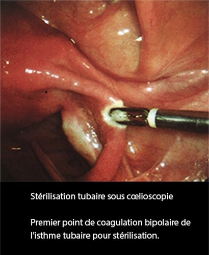 LDT_coelio 1