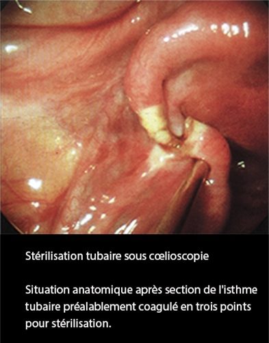 LDT_coelio 2