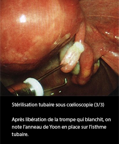 LDT_coelio 5