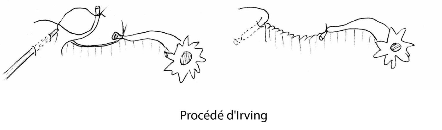 LDT_irving