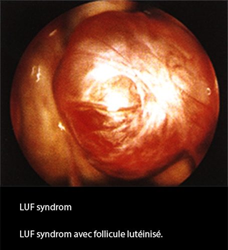 LUF-SD 1