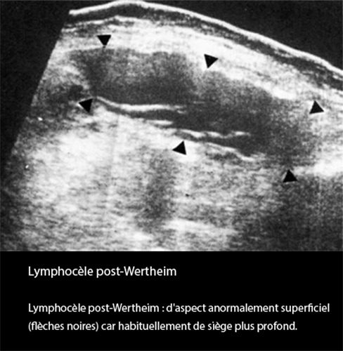 Lymphocèle