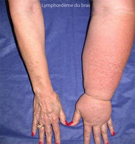 Lymphœdème du bras — complication post-chirurgie cancer du sein