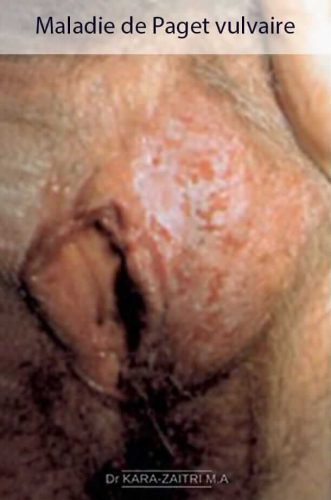 Lésions rouges de la vulve - Maladie de Paget vulvaire — carcinome intraépithélial de la vulve