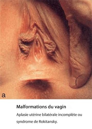 malformations vaginales