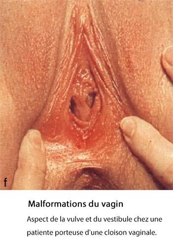 malformations vaginales