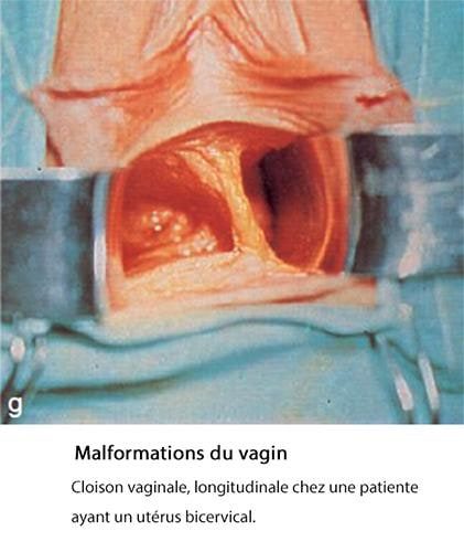 malformations vaginales