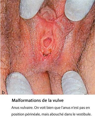 Malf_vulve 2