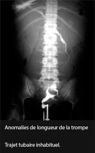 Malformations tubaires 1