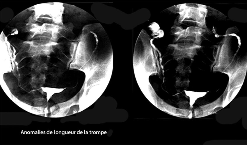 Malformations tubaires 2