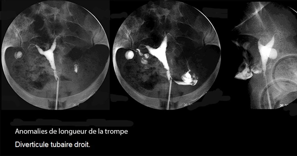 Malformations tubaires 3