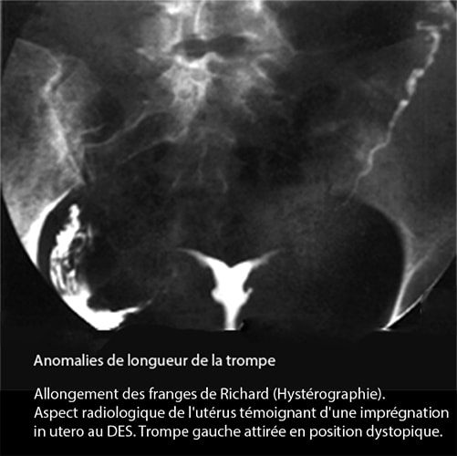 Malformations tubaires 4