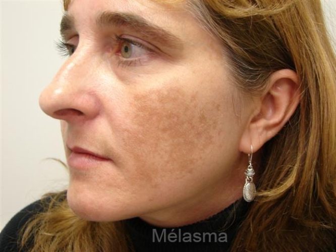 Mélasma1