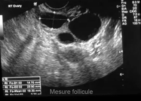 Mesure follicule