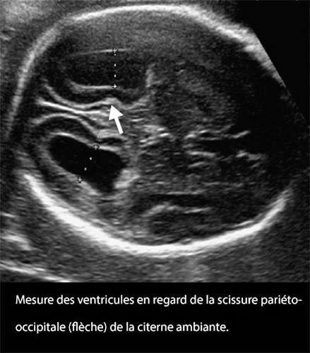 Mesure ventricules 1