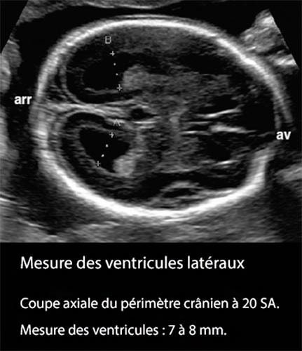 Mesure ventricules 2