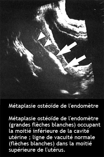 Métaplasie ostéoïde endométriale — calcifications utérines hystéroscopie 1