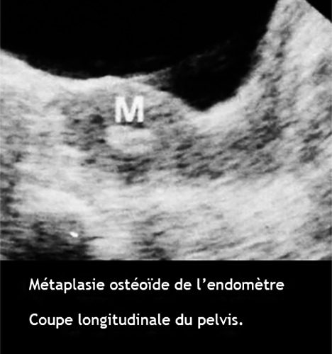 Métaplasie ostéoïde endométriale — calcifications utérines hystéroscopie 2