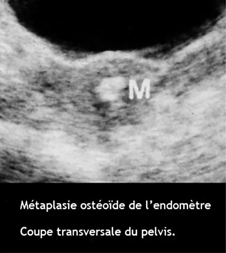 Métaplasie ostéoïde endométriale — calcifications utérines hystéroscopie 3