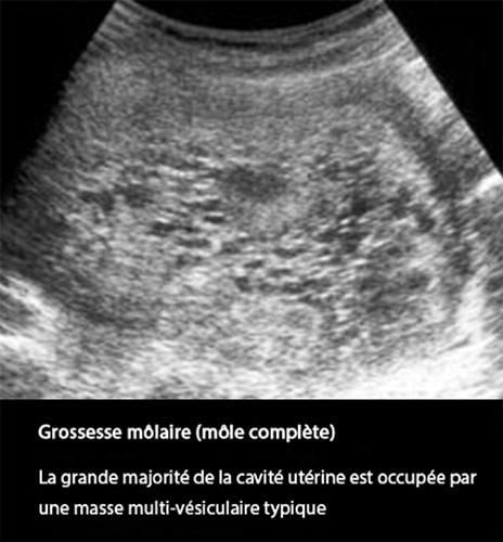 Môle 1
