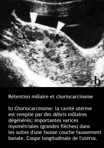 Môle hydatiforme — grossesse molaire image macroscopique 10