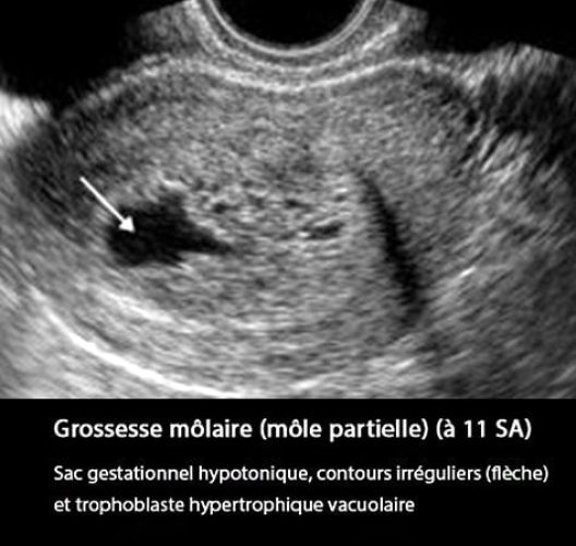 Môle hydatiforme — grossesse molaire image macroscopique 2
