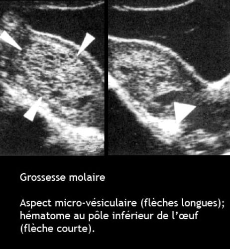 Môle hydatiforme — grossesse molaire image macroscopique 3