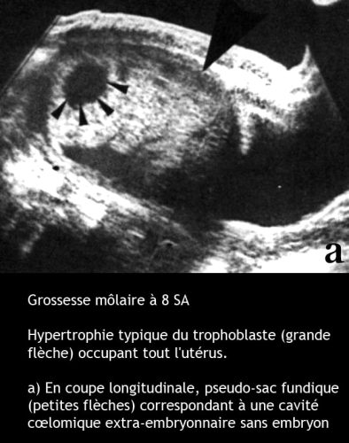 Môle hydatiforme — grossesse molaire image macroscopique 4
