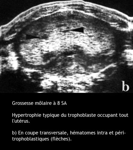 Môle hydatiforme — grossesse molaire image macroscopique 5