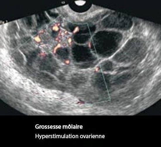 Môle hydatiforme — grossesse molaire image macroscopique 6