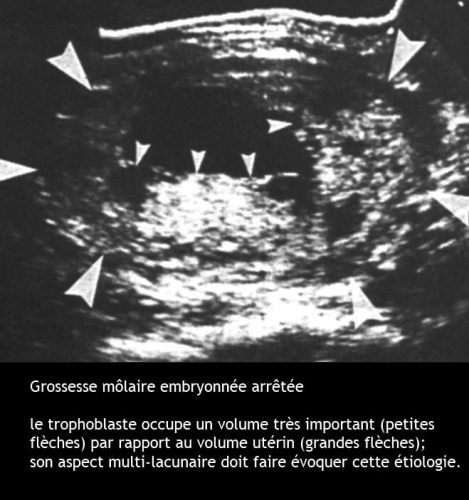 Môle hydatiforme — grossesse molaire image macroscopique 7