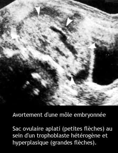 Môle hydatiforme — grossesse molaire image macroscopique 8