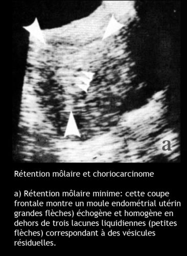 Môle hydatiforme — grossesse molaire image macroscopique 9