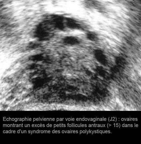 OPK — ovaires polykystiques image échographique 2