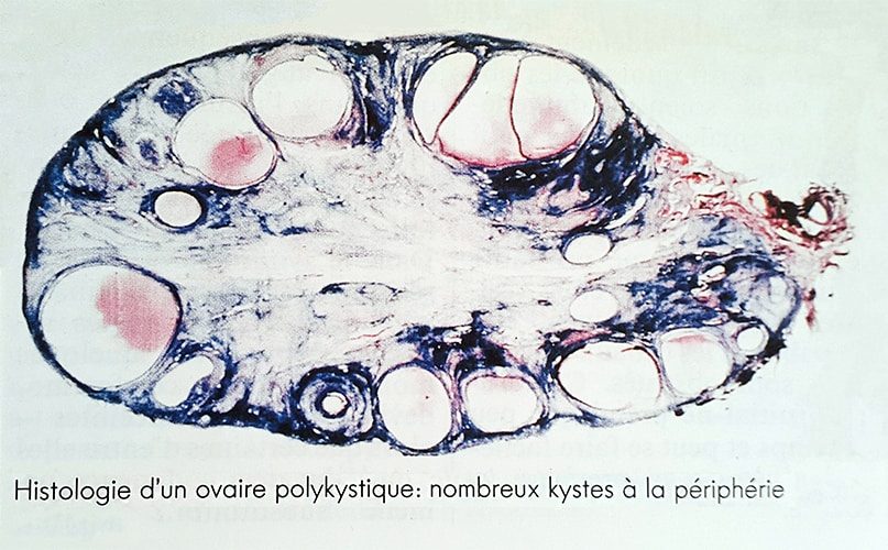 OPK histologie — aspect microscopique ovaire polykystique coupe histologique