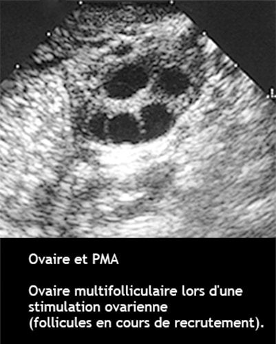 Ovaire multifolliculaire_pma