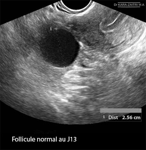 Ovaire normal _follicule 1