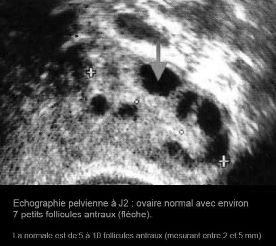 Ovaire normal jour 2 — échographie ovarienne follicules antraux