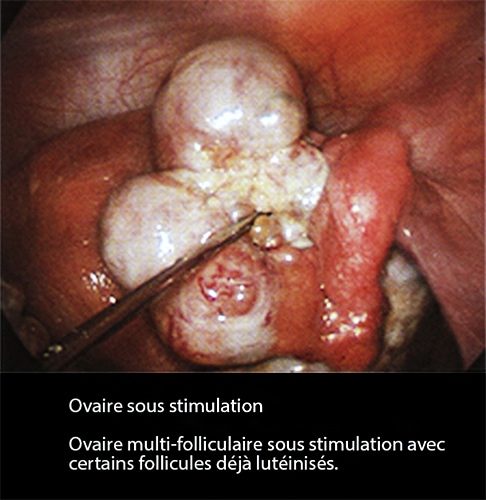 Ovaire sous stimulation_coelio