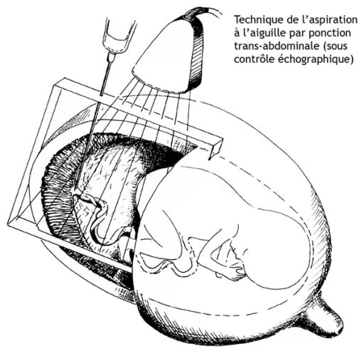 Placenta site fixation 1 — localisation placentaire échographie
