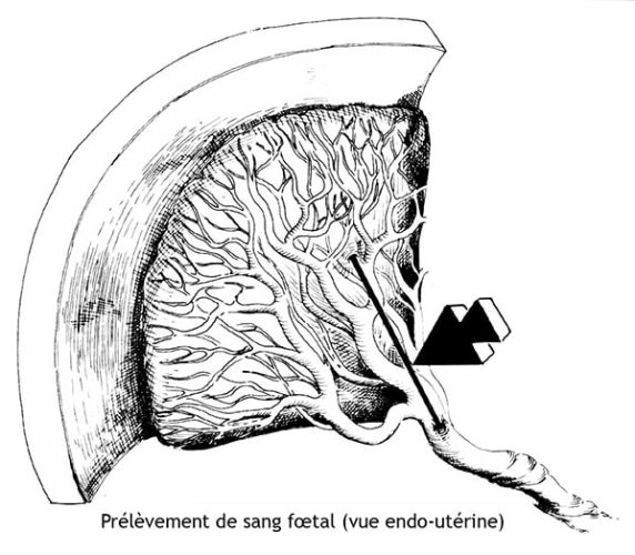 Placenta site fixation 2 — localisation placentaire échographie
