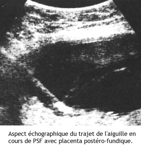 Placenta site fixation 3 — localisation placentaire échographie